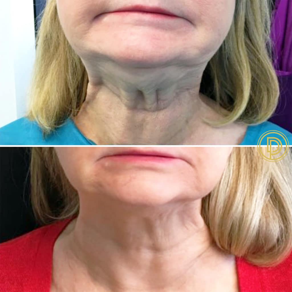 botox for neck bands