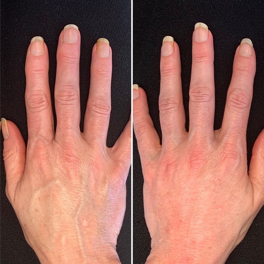 restylane filler to hands - hand rejuvenation