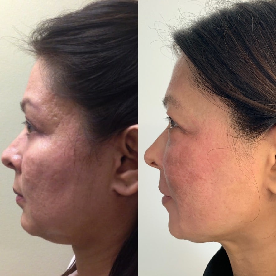 Kybella to Submental Fat