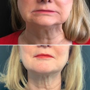 kybella for jowls