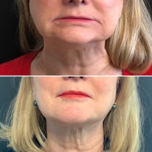 Can Fillers Fix Sagging Jowls Dallas Dermatology Partners