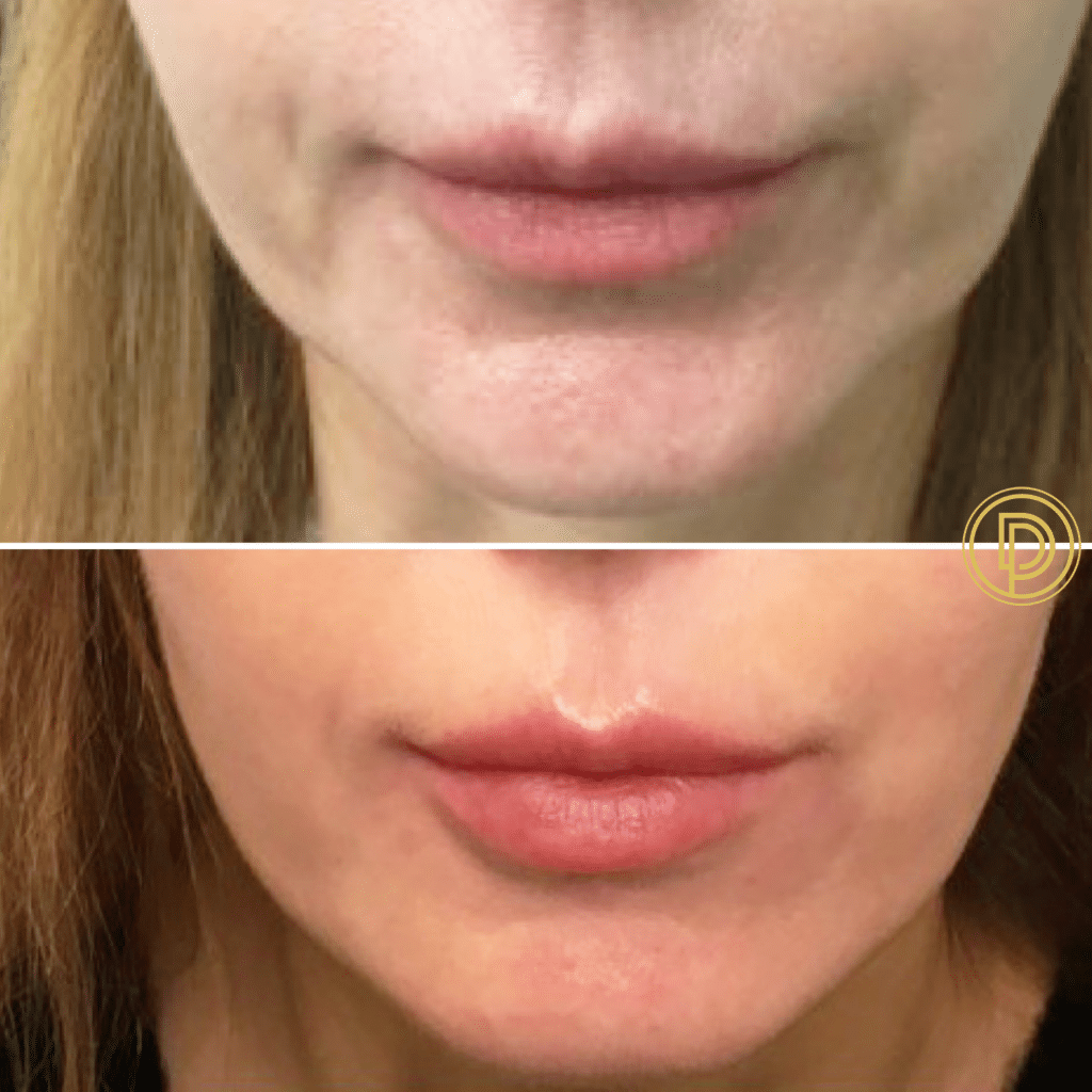 lip fillers