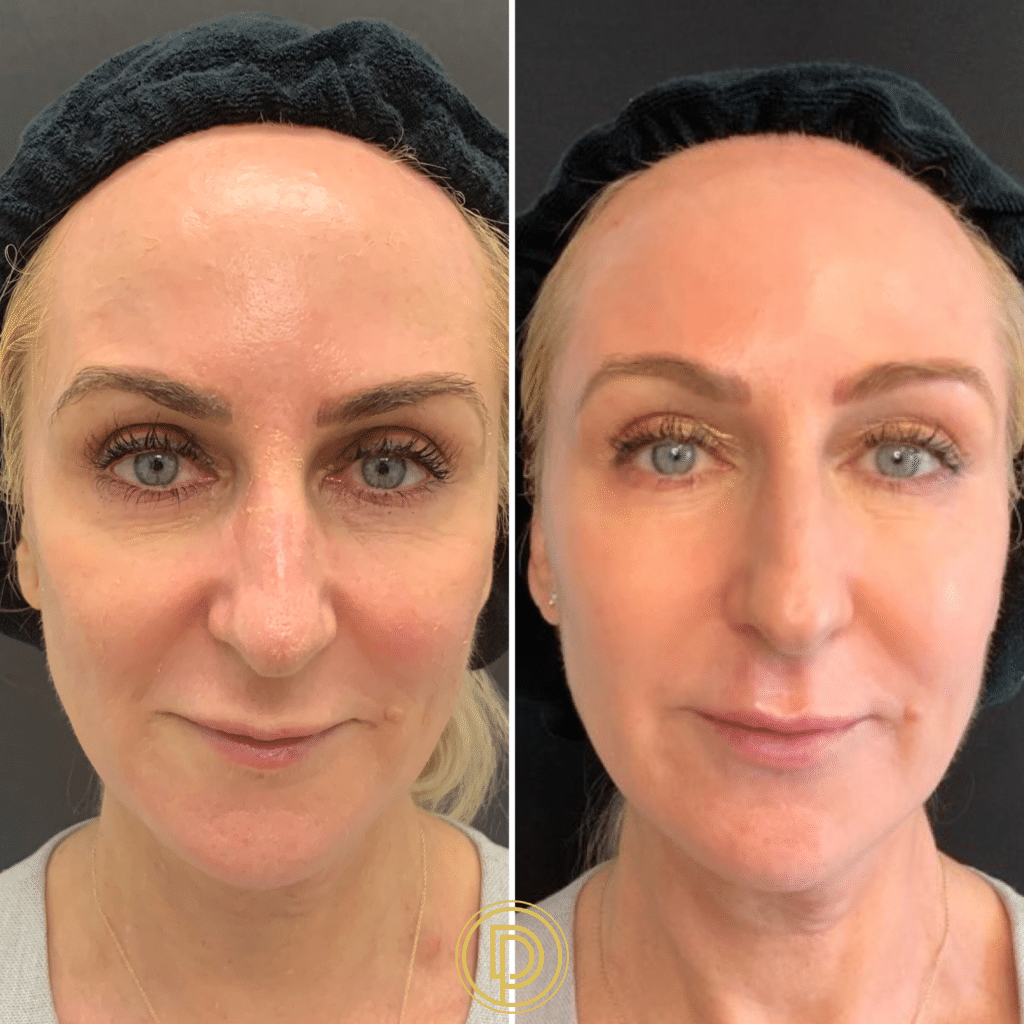 sculptra face filler