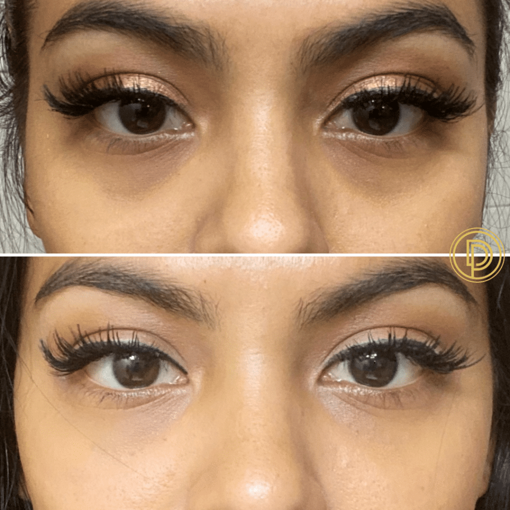 restylane under eye filler to tear troughs by dr. dickson