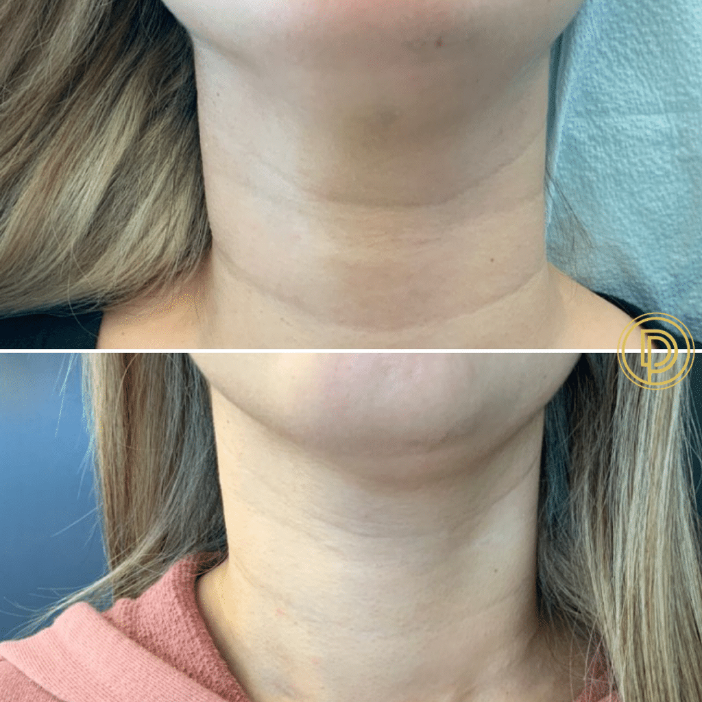 restylane refyne filler for necklace lines by dr. dickson
