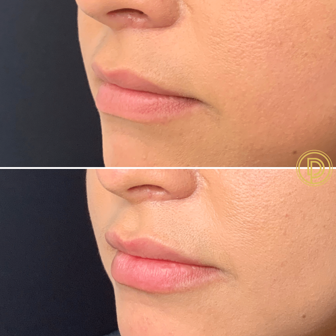 restylane lip filler