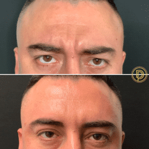mens forehead fillers