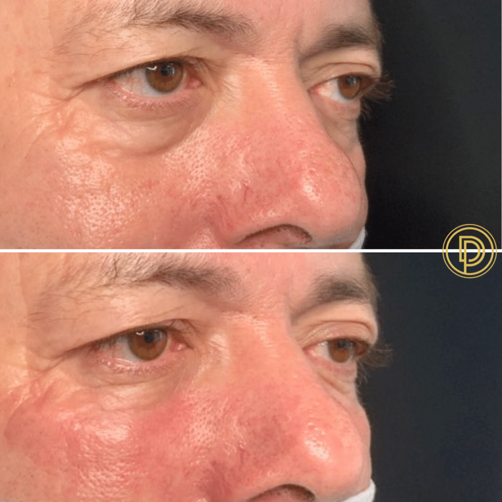 restylane eye filler