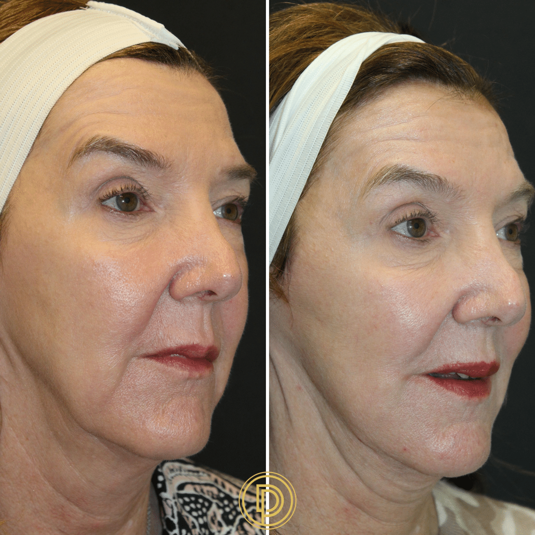 juvederm voluma cheek and jaw filler by dr. dickson