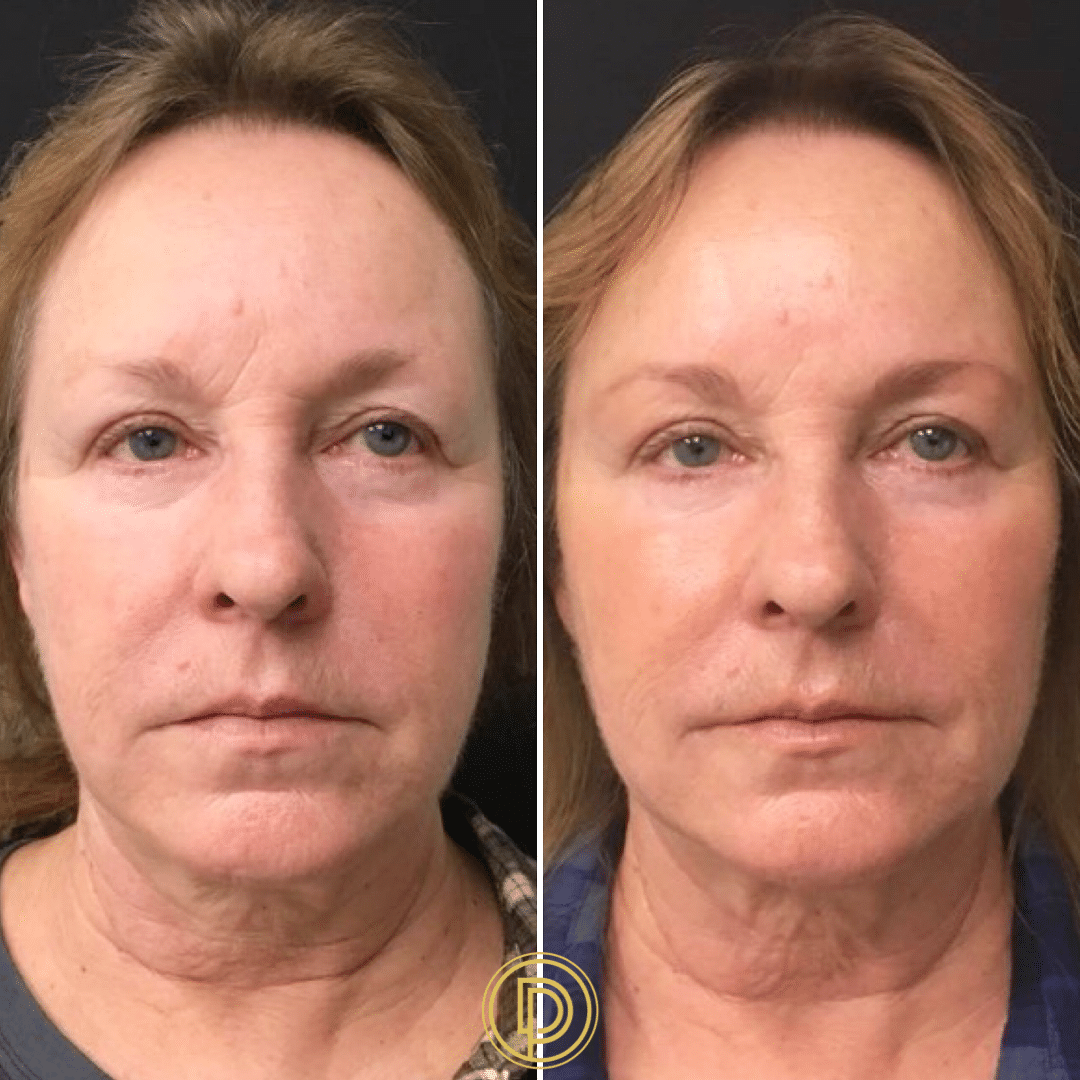 juvederm voluma cheek filler to midface by dr. dickson