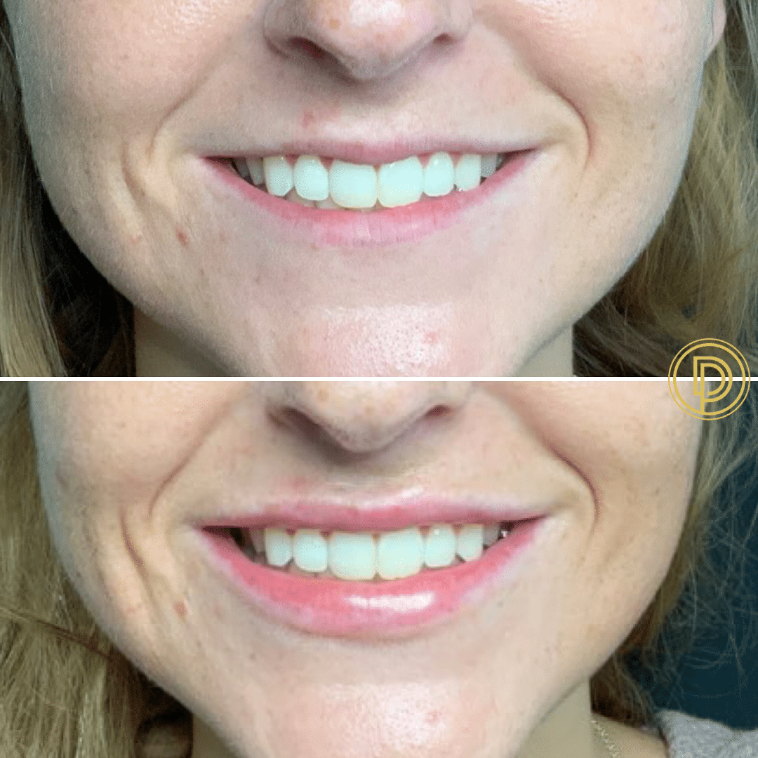 restylane lip filler injections