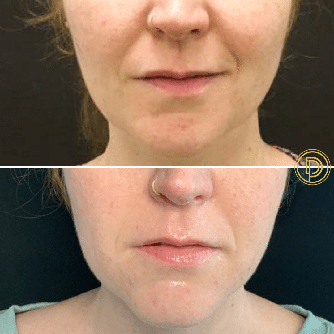 juvederm filler in nose lips and face