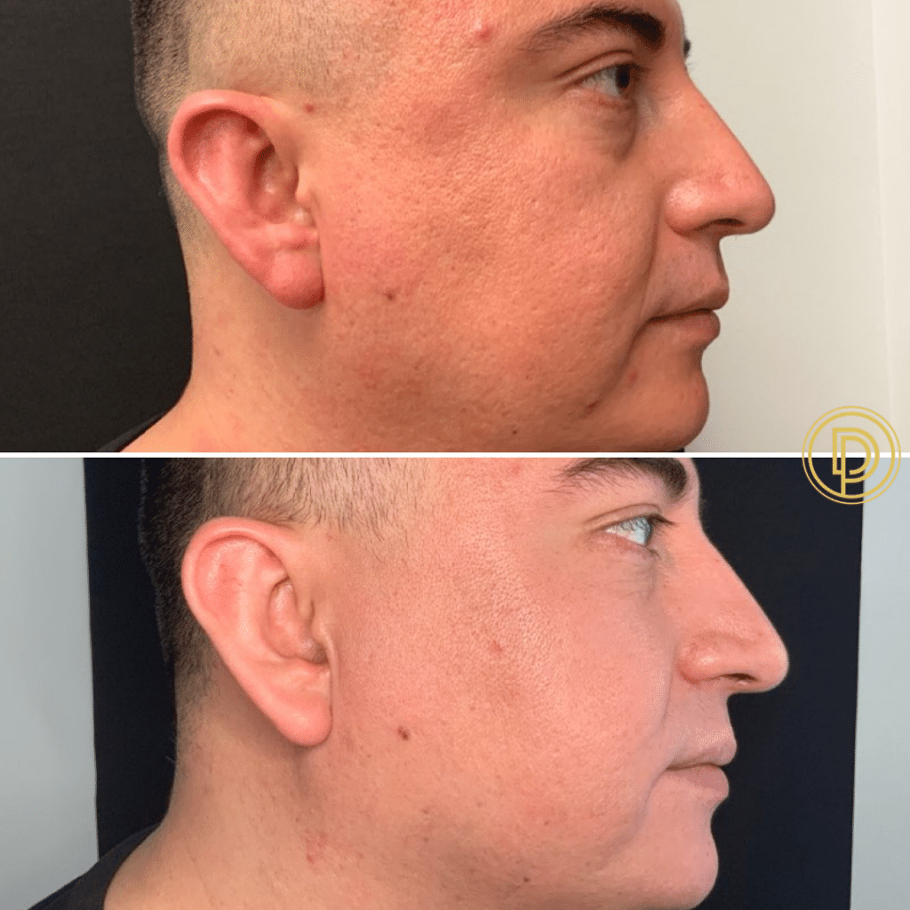 microneedling for smaller pores