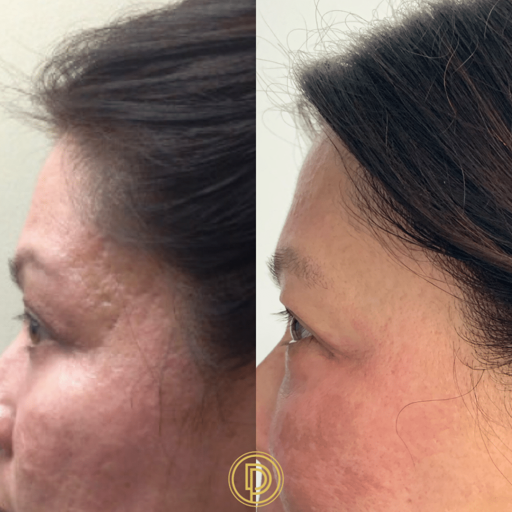 microneedling treatment for acne scars