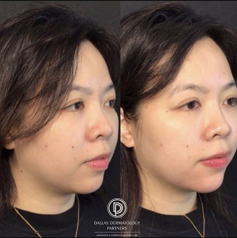 before and after chin filler