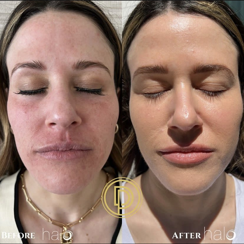 before and after halo laser