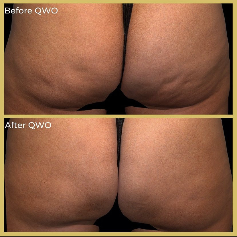 before and after qwo