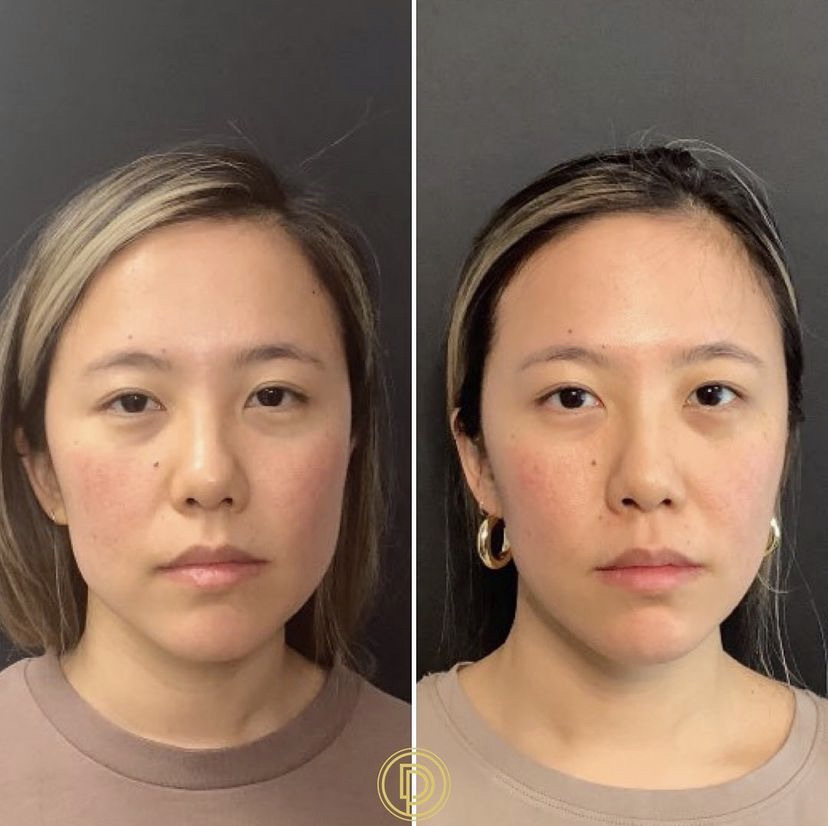 botox dysport for tmj masseter muscle
