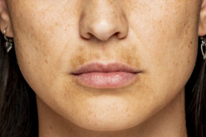 sun mustache treatment melasma on upper lip