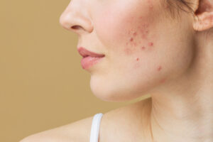 hormonal acne treatment