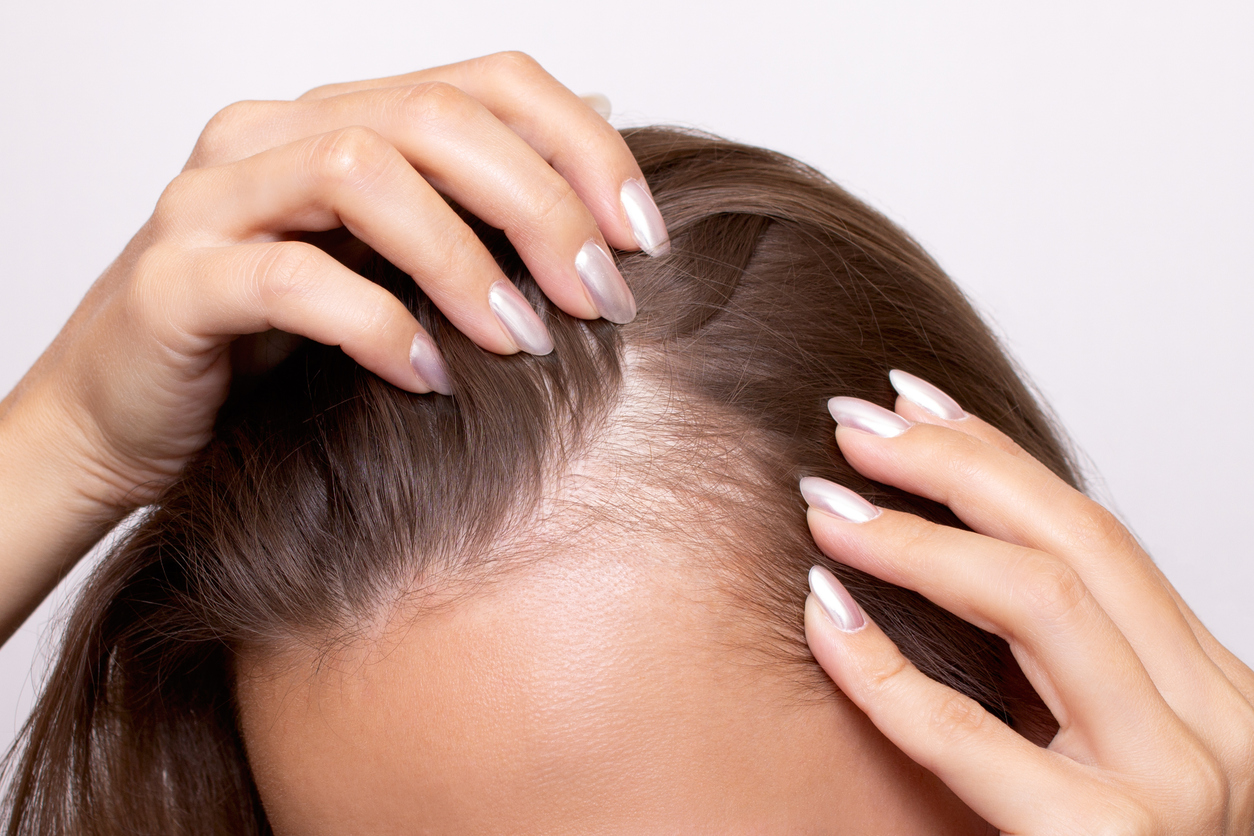 Can a Dermatologist Do Anything for Female Hair Loss Dallas Derm Partners