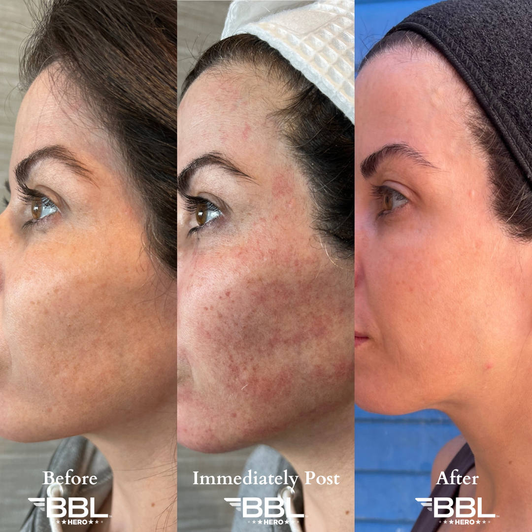 BBL Hero Dallas Broadband Light Therapy Dallas Dallas Dermatology Partners