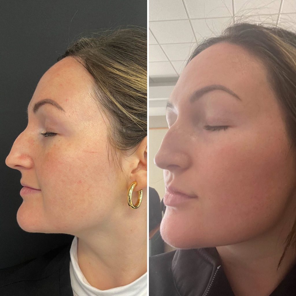 moxi laser before 5 days after