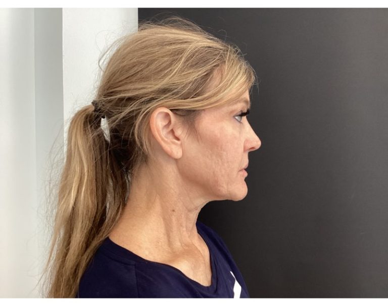 Genius RF Microneedling Acne Scars Dallas Derm Partners