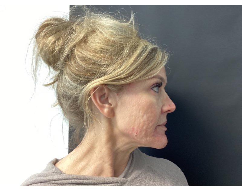 genius rf microneedling acne scar treatment before