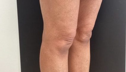 genius rf microneedling knees after