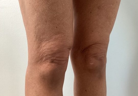 genius rf microneedling knees before