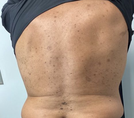 vi precision peel plus back after