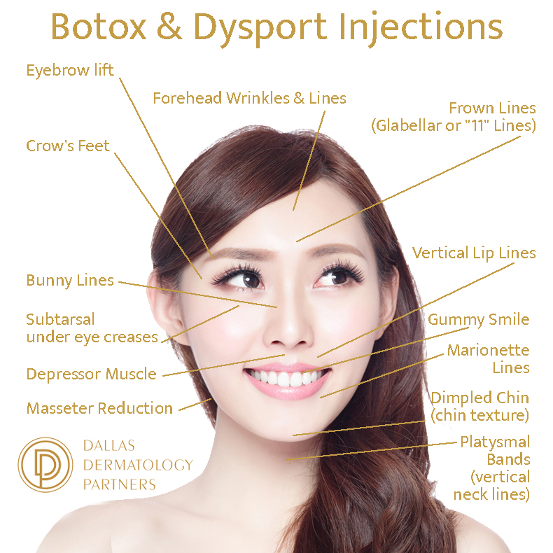 botox dysport injection sites
