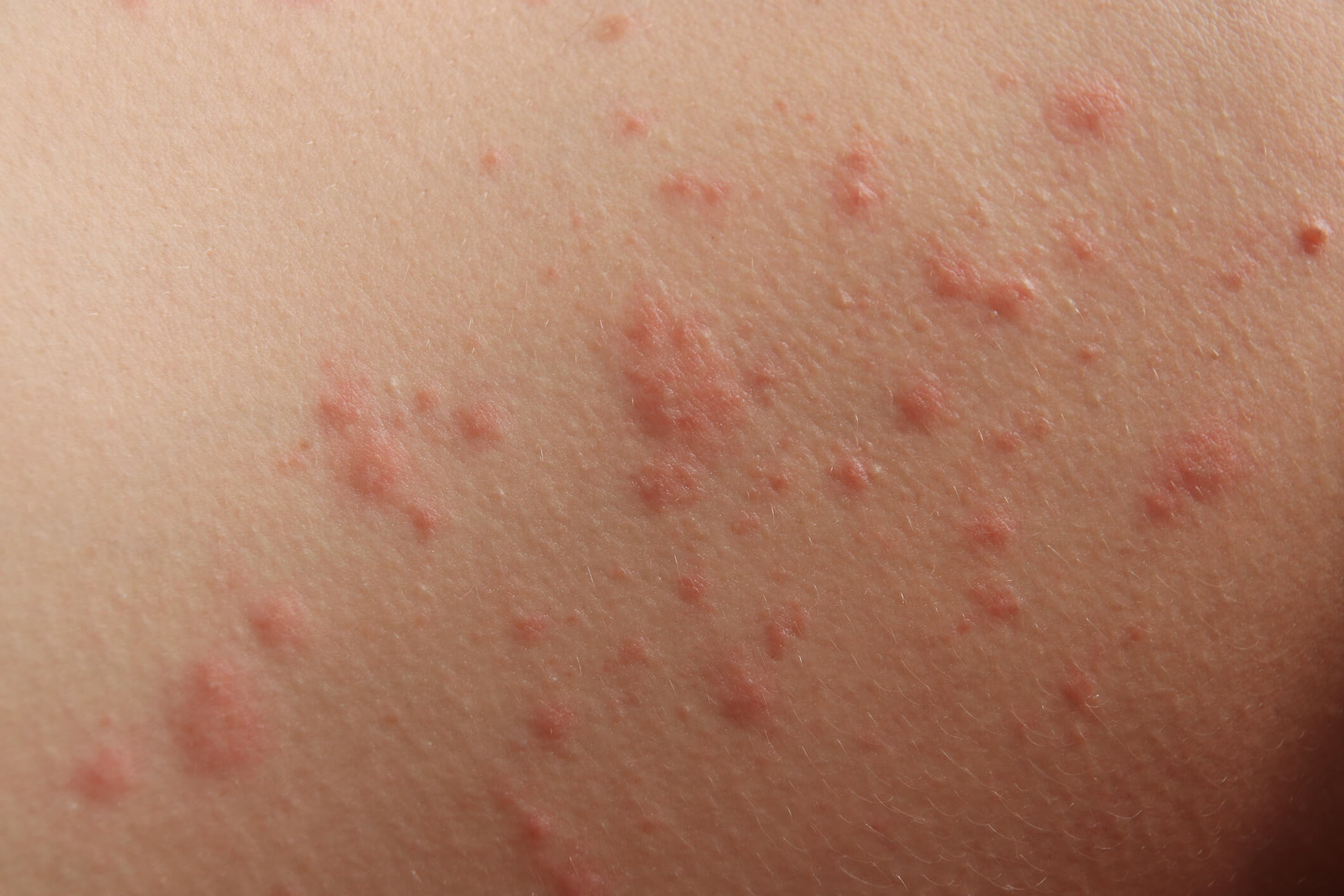 contact dermatitis