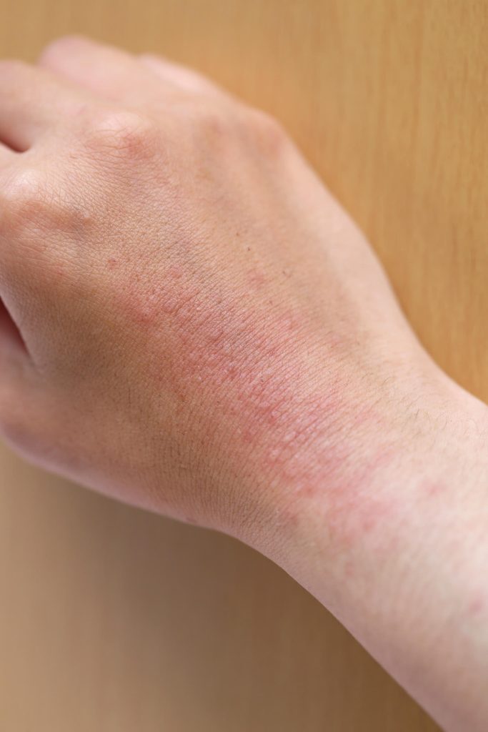 eczema breakout