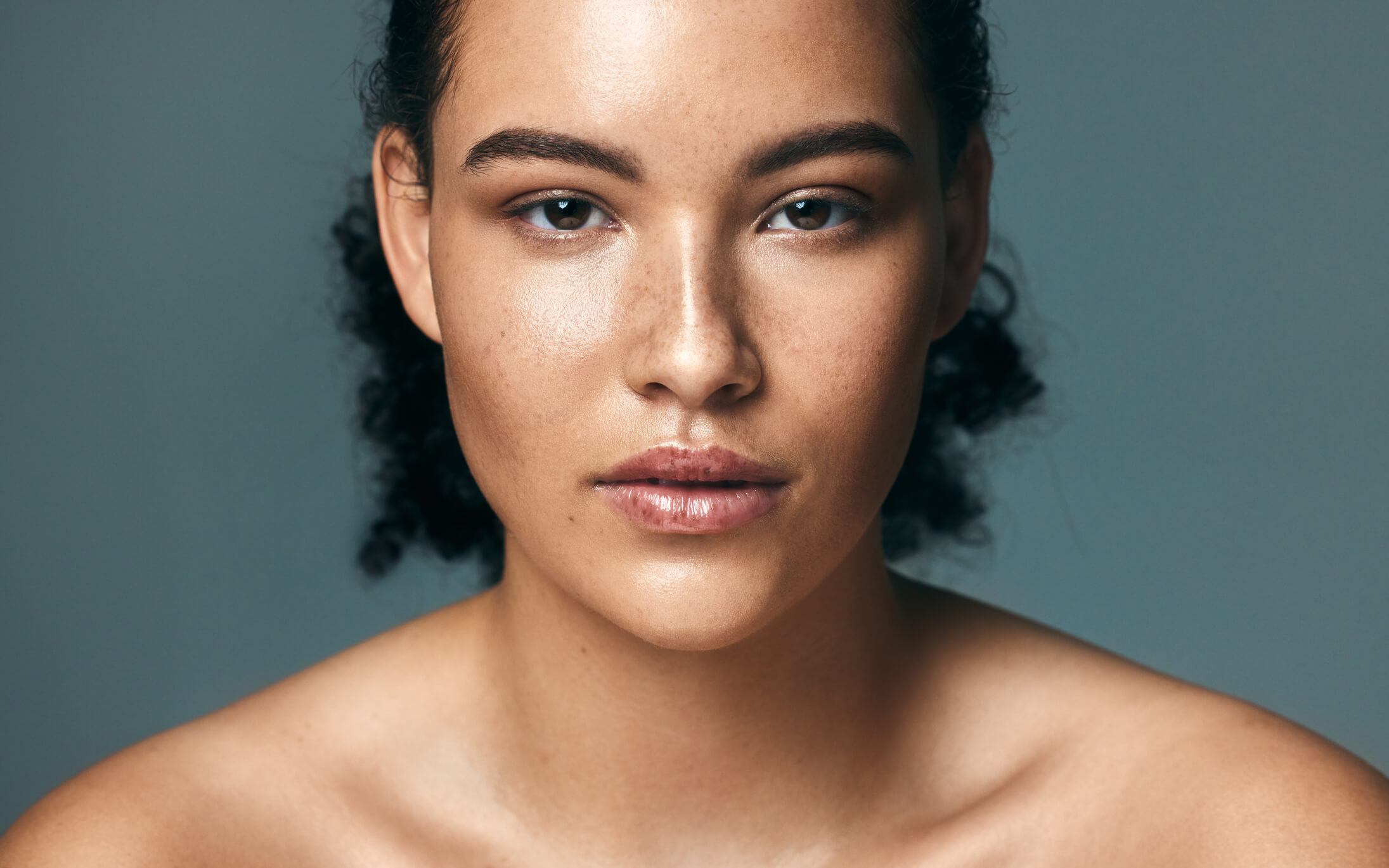 hyperpigmentation on face