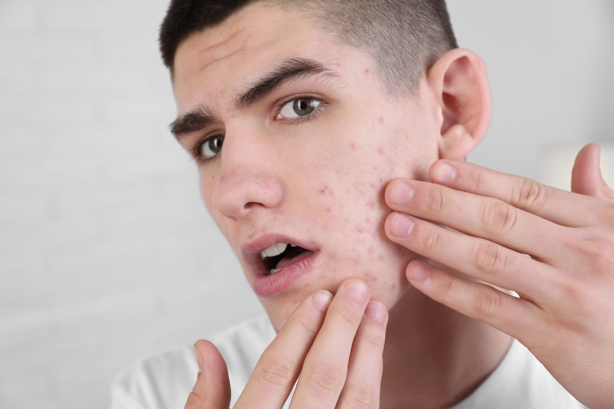 mens acne treatment