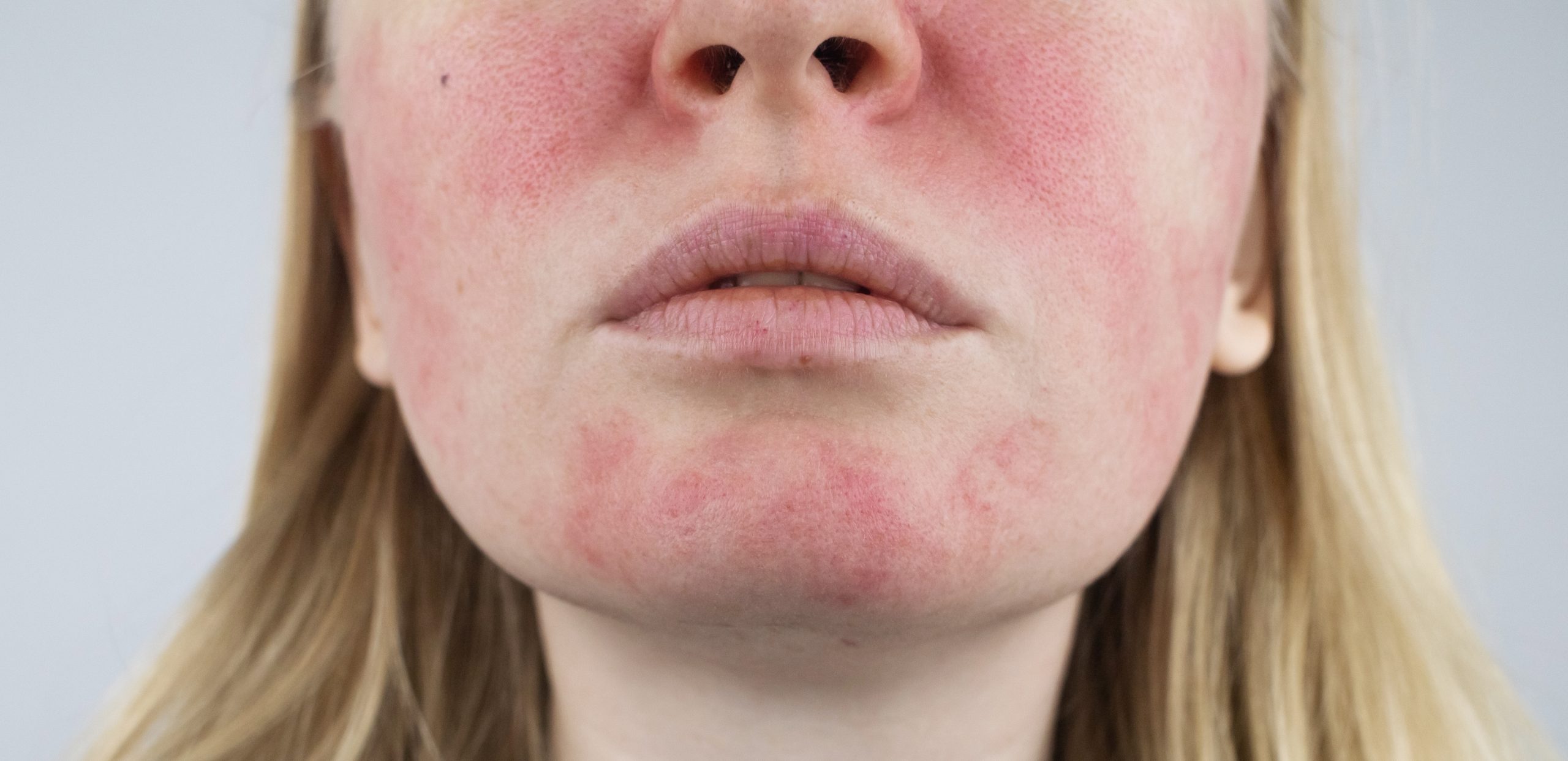 rosacea on face