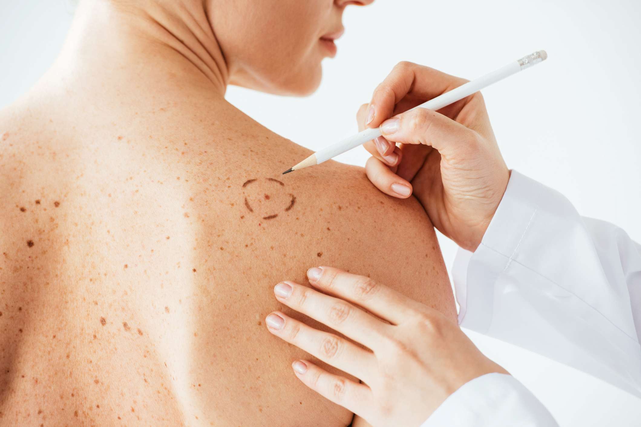 skin cancer screening skin cancer screening