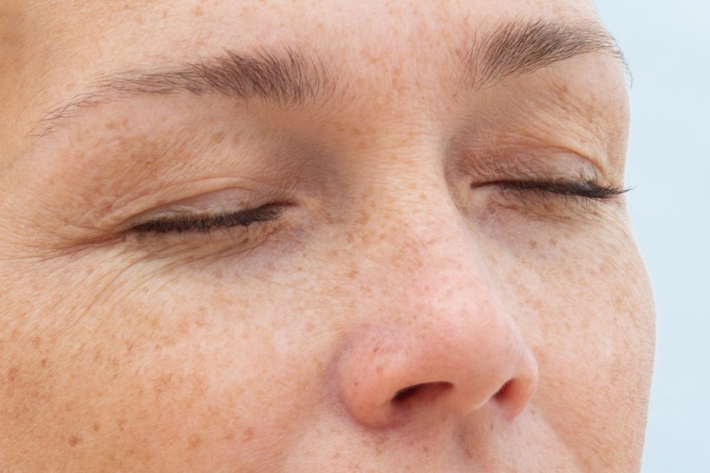 upper eyelid sagging wrinkles excess skin