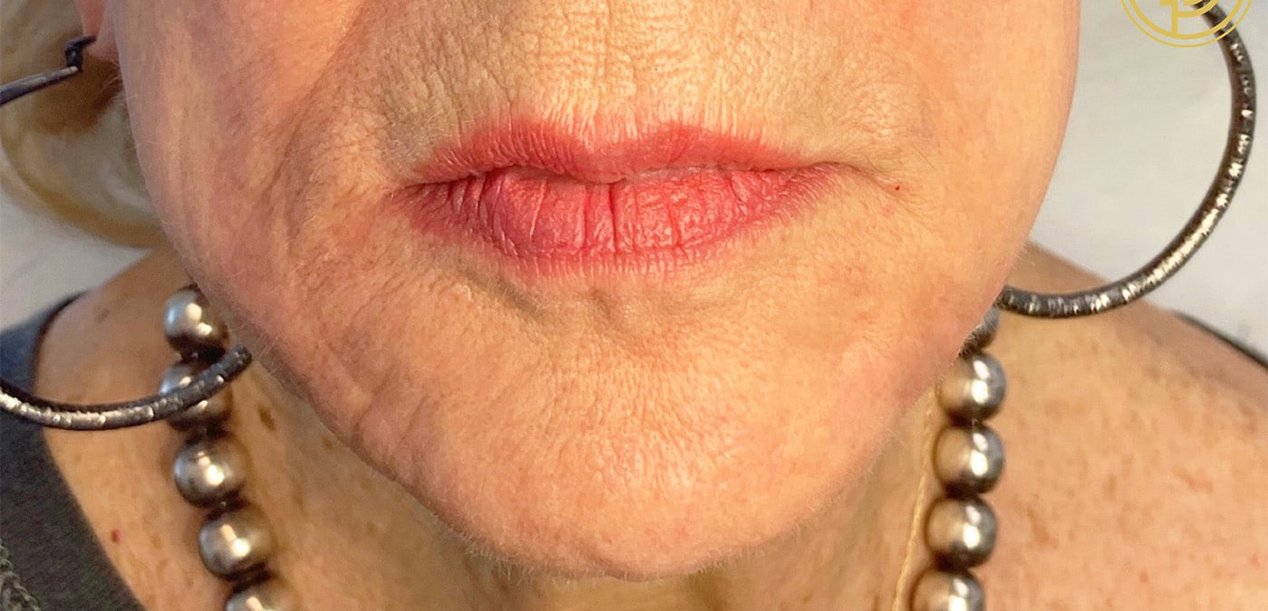 Juvederm Ultra Plus – Case 1