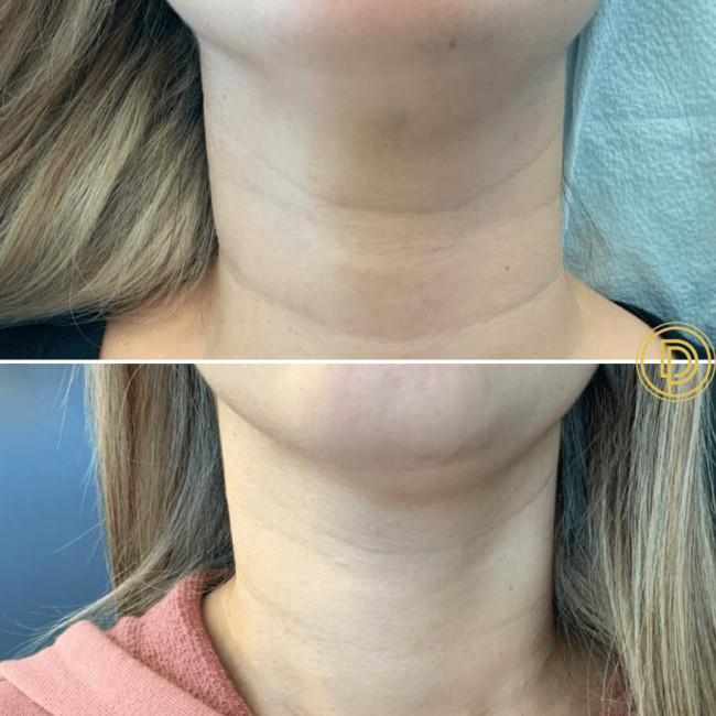 Restylane Case 4