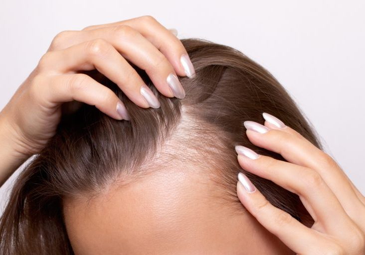 Young woman with hair loss showing bald spots on forehead and temples