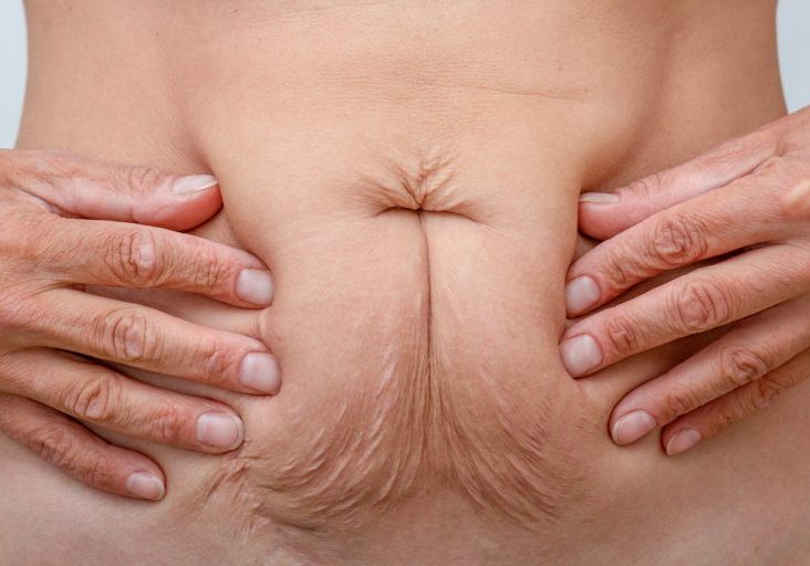 loose skin after weight loss