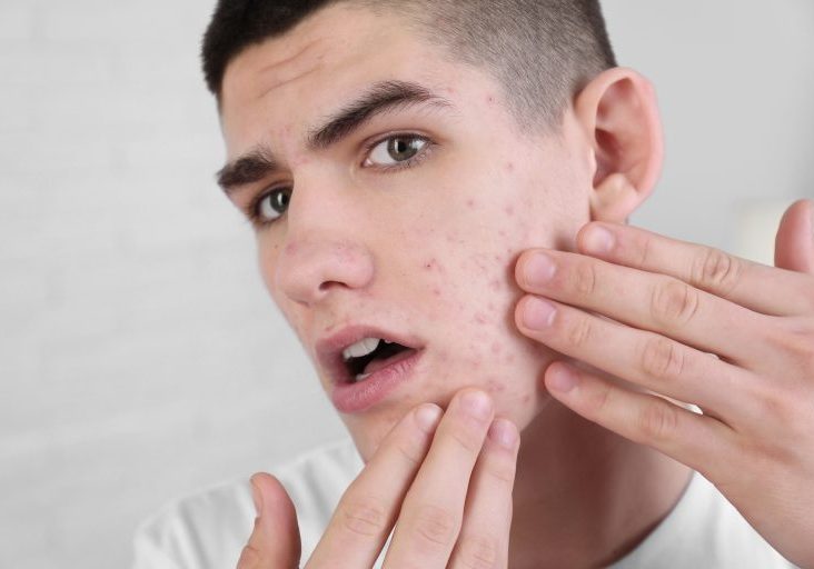 mens acne treatment