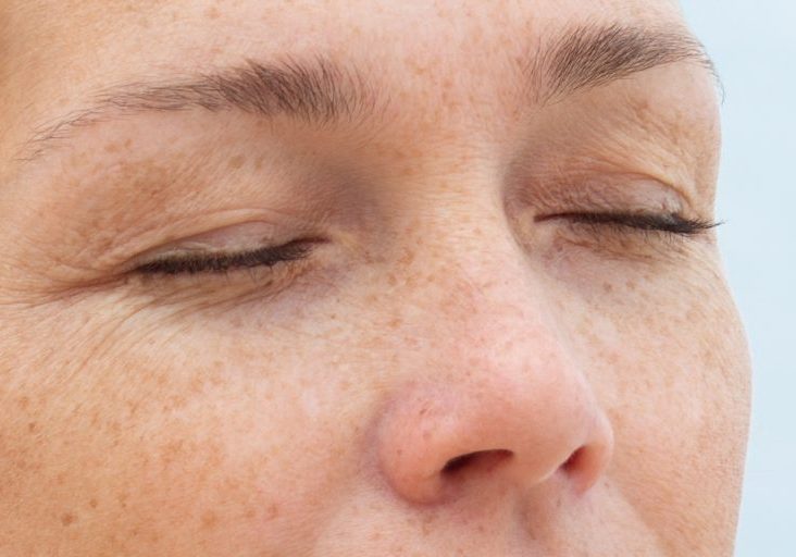 upper eyelid sagging wrinkles excess skin